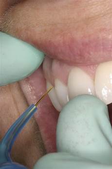 Dental Diode Laser