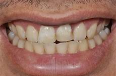 Dental Laser