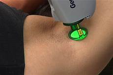 Diode Laser Hair Removal