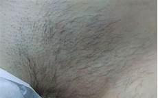 Diode Laser Hair Removal