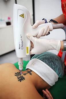 Dioe Laser Hair Removal