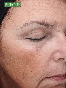 Dioe Laser Hair Removal