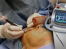 Ent Laser