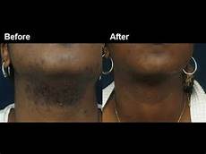 Ipl Laser Hair Removal