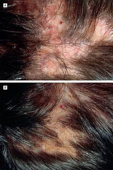 Ipl Laser Hair Removal