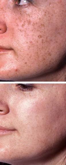 Ipl Laser Hair Removal