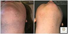 Laser Epilation Devices