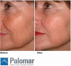 Laser Epilation System