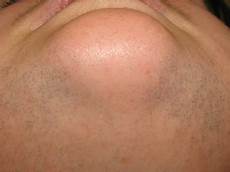 Laser Epilation System