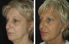 Laser Epilation