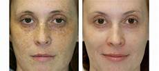 Laser Epilation