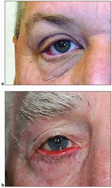 Laser Surgery