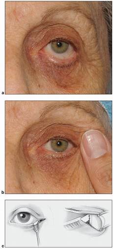 Laser Surgery