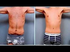 Laser Surgery