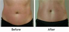 Lipo Laser Slimming