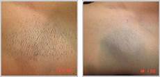 Medical Laser Devices