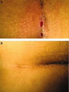 Nd-Yag Laser