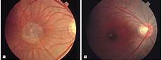 Nd-Yag Laser
