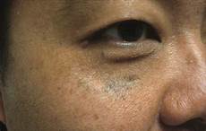Nd-Yag Laser