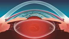 Ophthalmic Laser