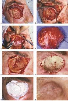 Ophthalmic Laser