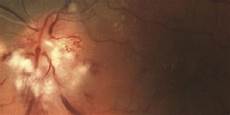 Ophthalmic Laser