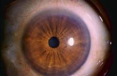 Ophthalmic Laser