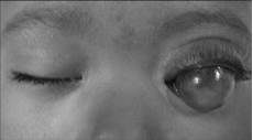 Ophthalmic Lasers