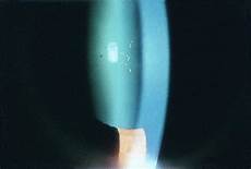Ophthalmologic Laser
