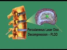 PLDD Laser