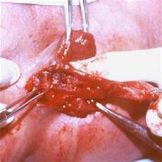 Preliminary Treatment