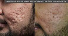 Surgical Laser