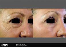 Surgical Laser